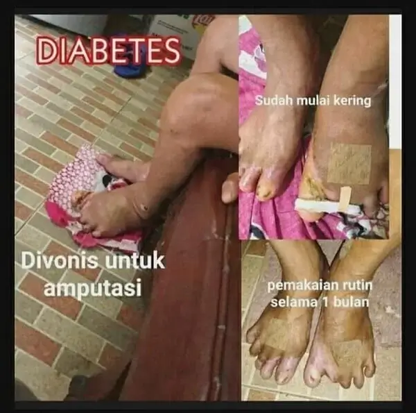 Testimoni Diabetes One More International